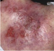 Example of baseline upper back skin prior to ZEVASKYN™ (prademagene zamikeracel) treatment