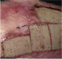 Example of ZEVASKYN™ (prademagene zamikeracel) wound healing at day 0 after surgery