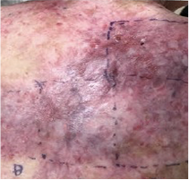 Example of ZEVASKYN™ (prademagene zamikeracel) wound healing during long-term follow-up