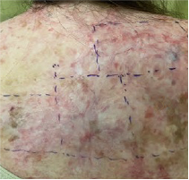 Example of ZEVASKYN™ (prademagene zamikeracel) wound healing at the end of long-term follow-up