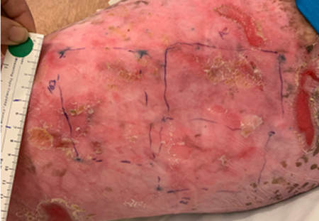 Example of RDEB wound healing at week 24 with ZEVASKYN™ (prademagene zamikeracel)