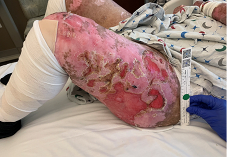 Example of RDEB baseline wounds on left thigh
