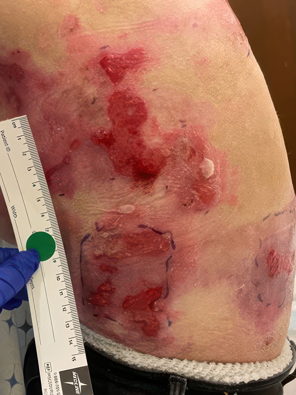 Left side of torso before ZEVASKYN treatment
