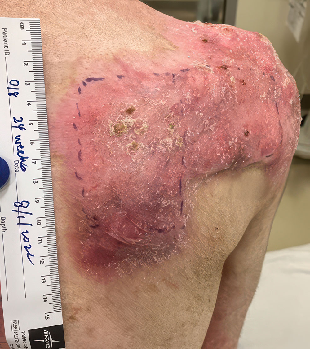 After ZEVASKYN RDEB back wound