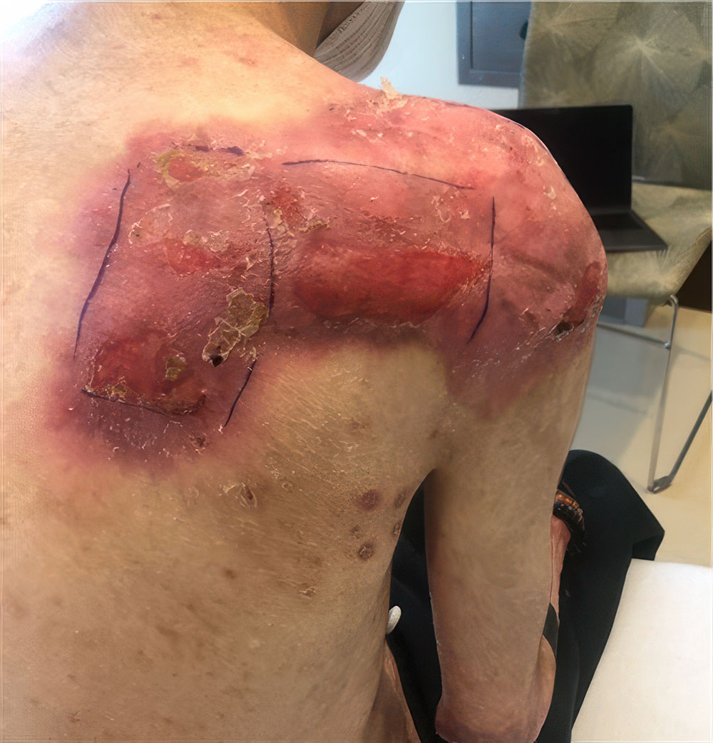 Before ZEVASKYN RDEB back wound