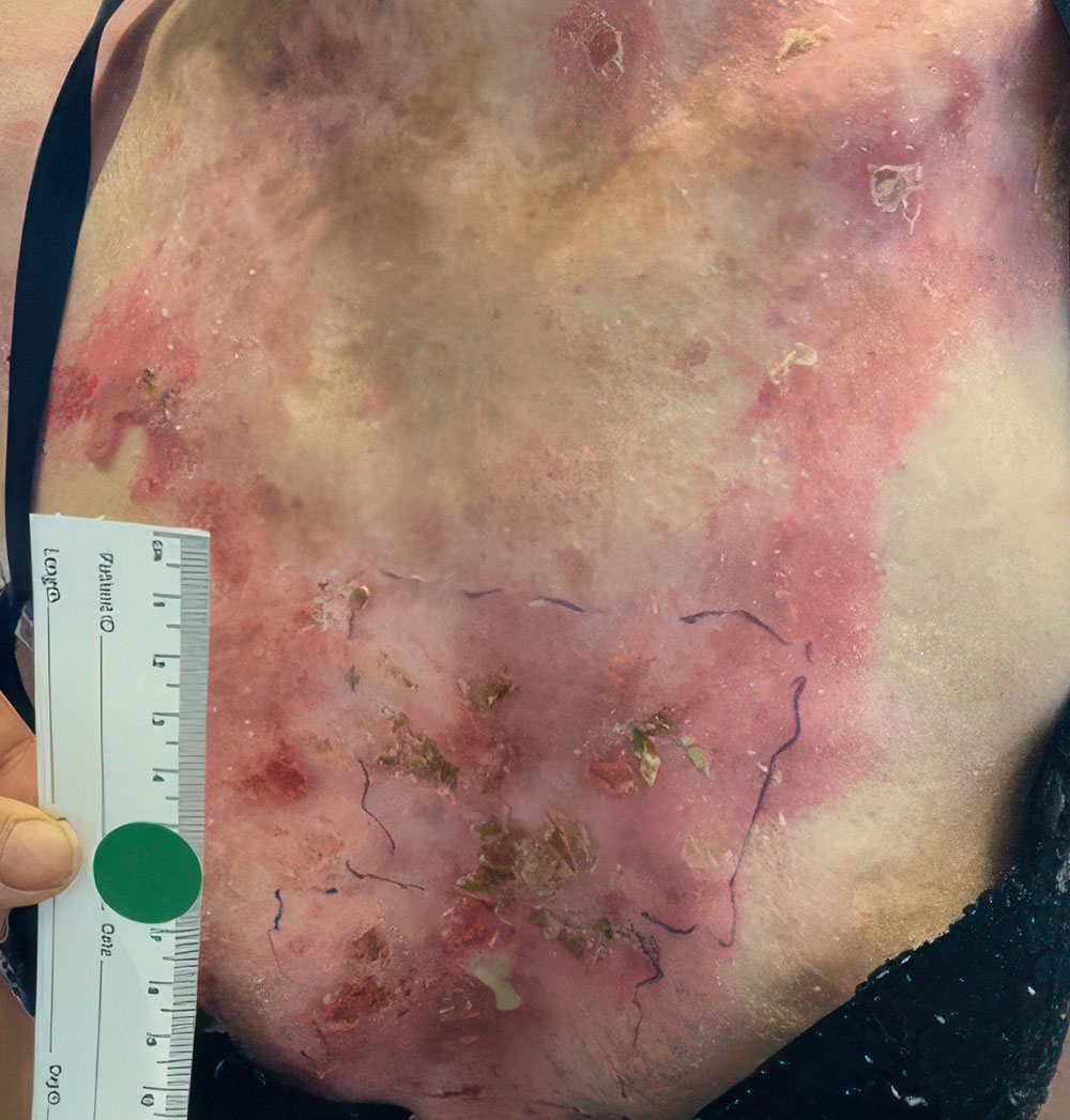 After ZEVASKYN RDEB chest wound