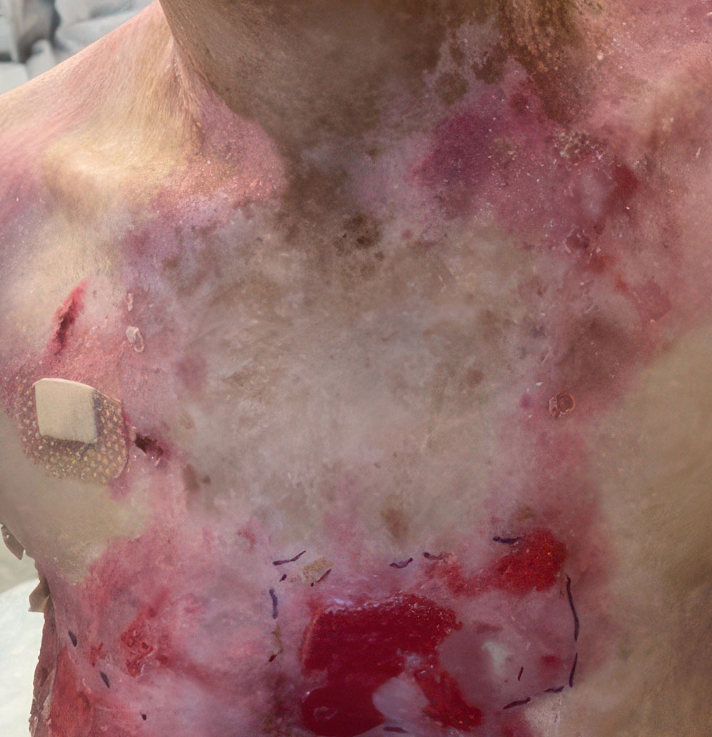 Before ZEVASKYN RDEB chest wound
