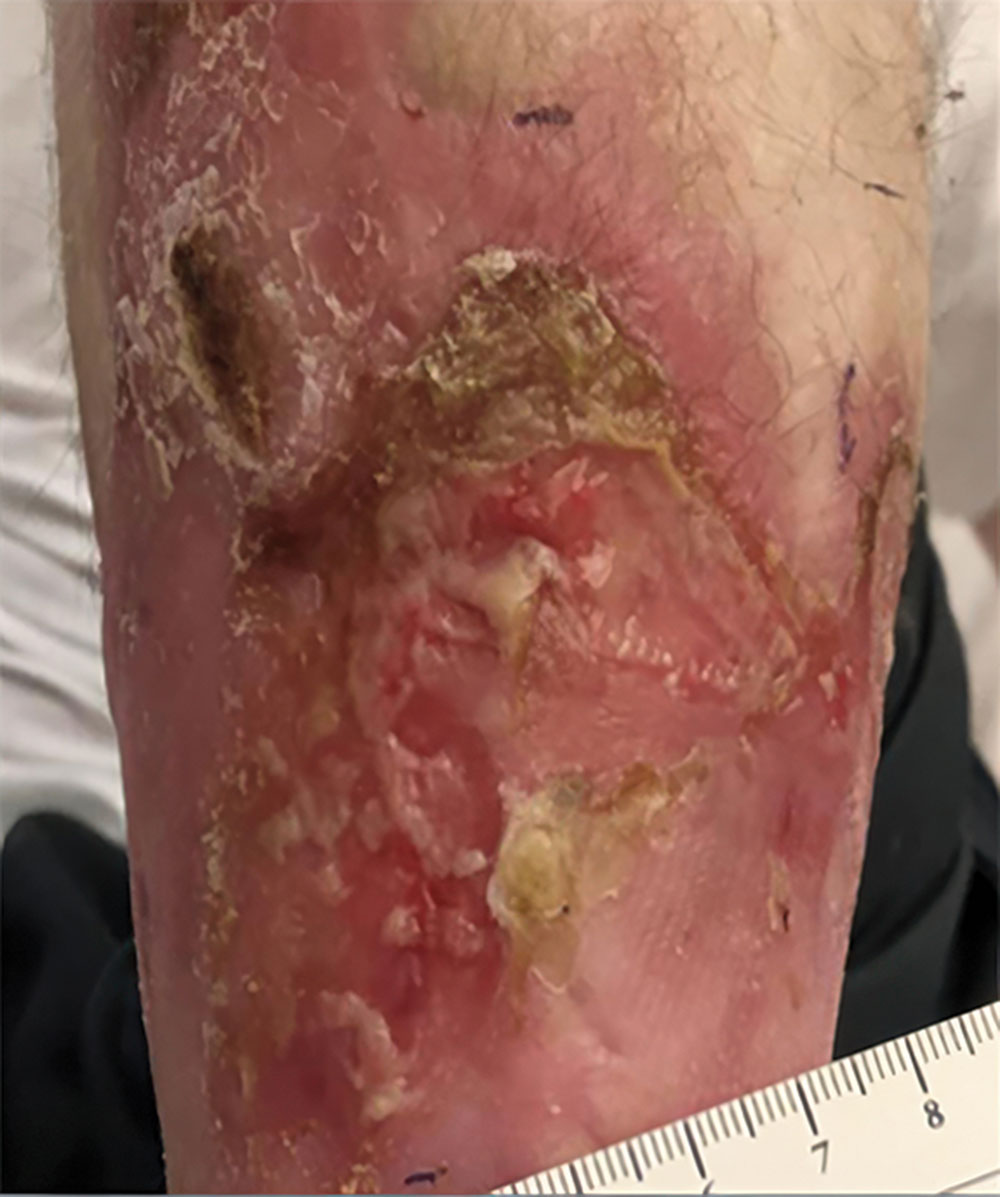 Before ZEVASKYN RDEB left leg wound