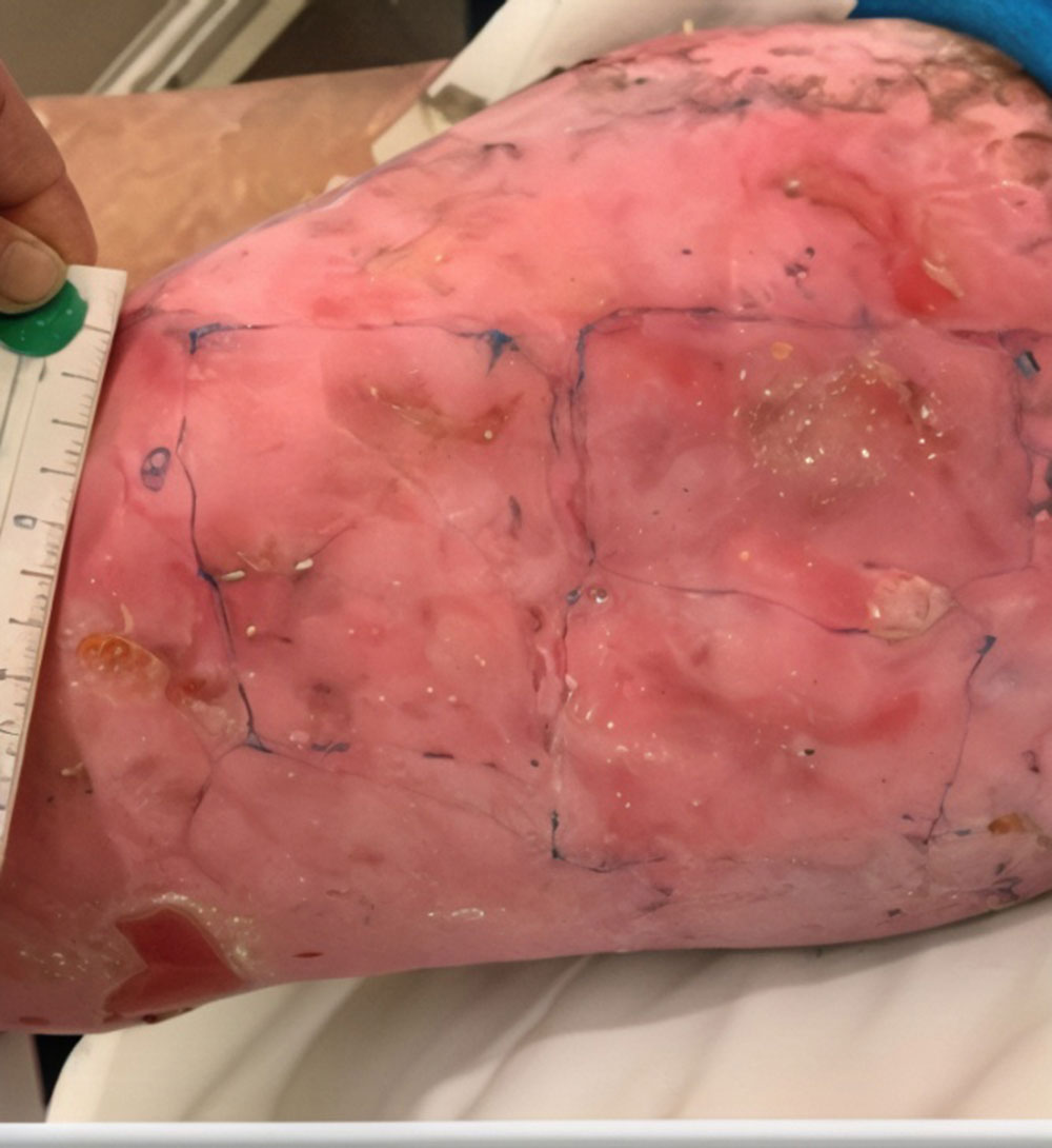 After ZEVASKYN RDEB left thigh wound