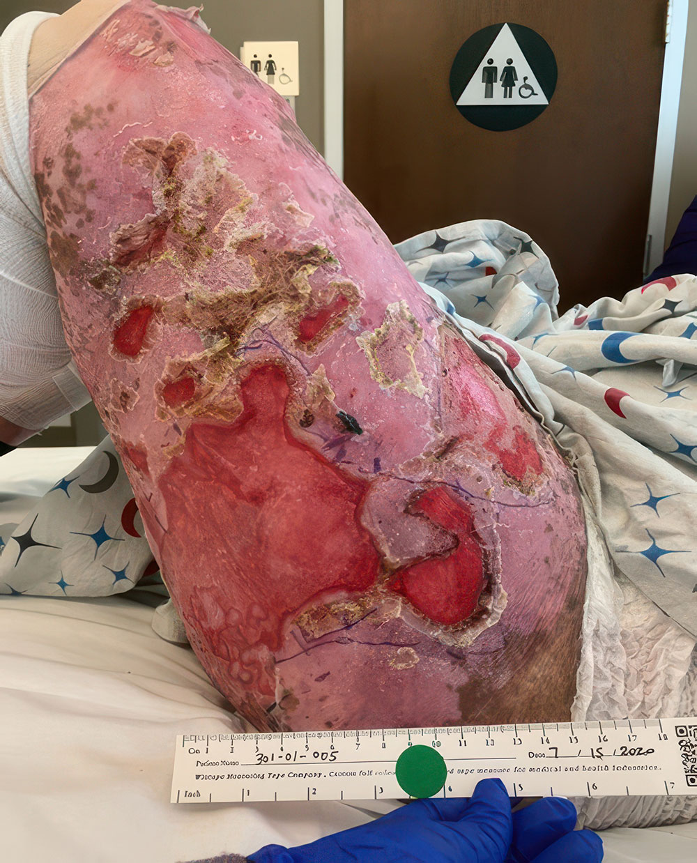 Before ZEVASKYN RDEB left thigh wound