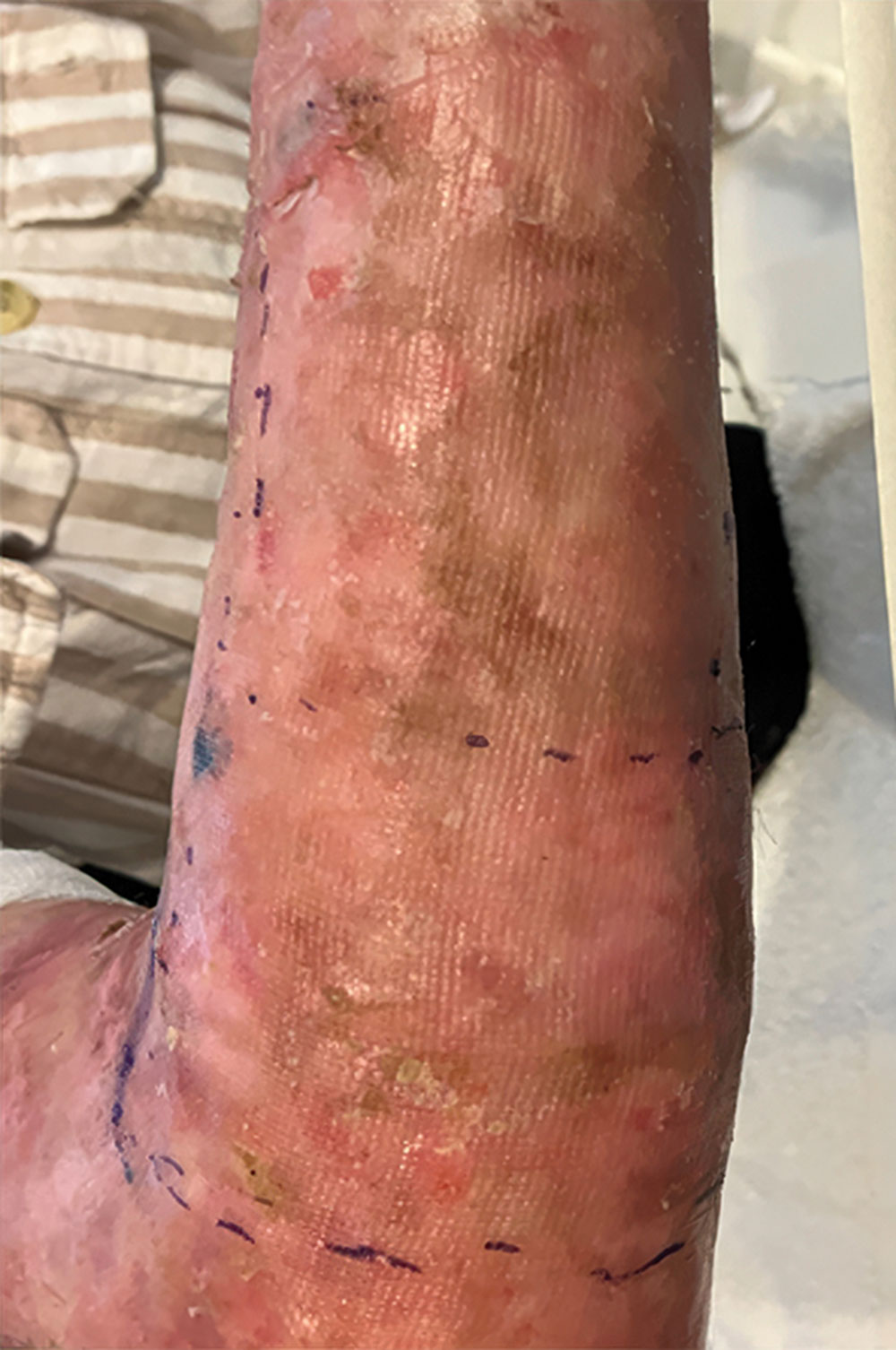 After ZEVASKYN RDEB right arm wound