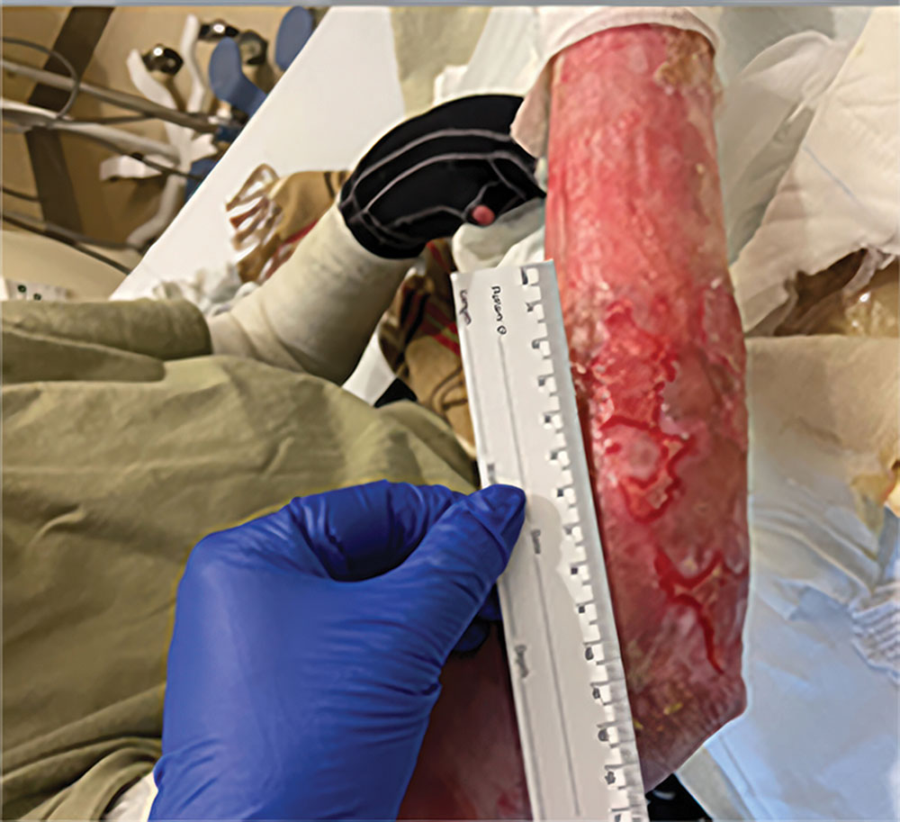 Before ZEVASKYN RDEB right arm wound