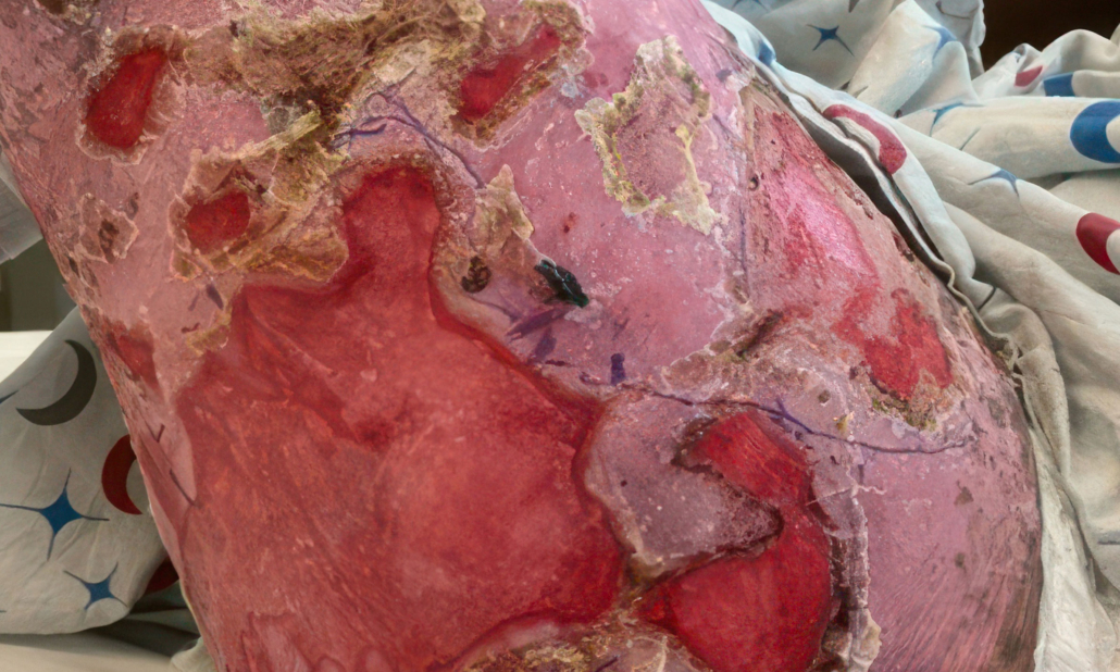 Left thigh before ZEVASKYN treatment