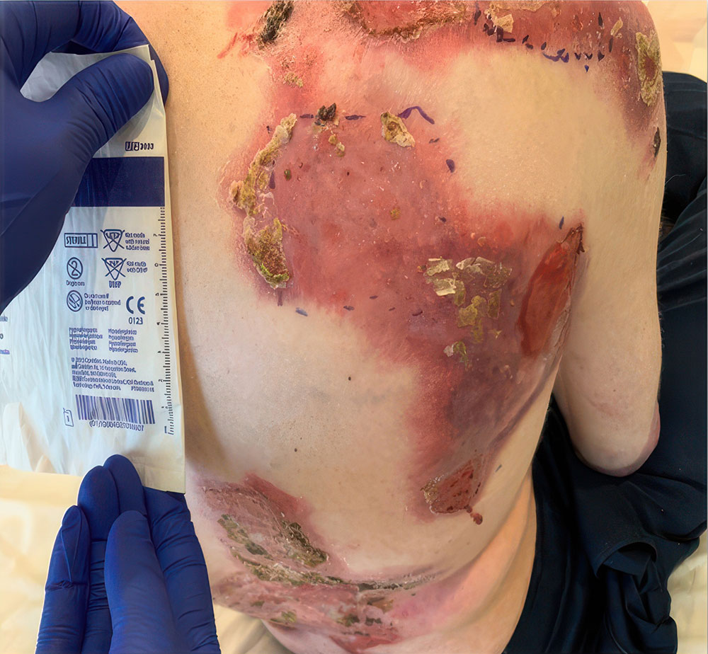 After ZEVASKYN RDEB upper back wound