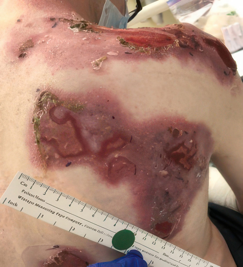 Before ZEVASKYN RDEB upper back wound